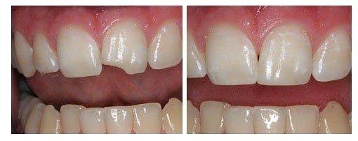 Repair-Chipped-Tooth