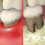 periodontal-disease-150×150