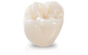  Natural and Metal Free Teeth replacement
