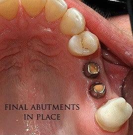 dental-implant-middle