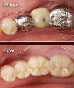 Zirconium-Crown-Before-and-After-253×300