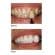 Teeth Whitening