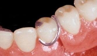  Metal Partial Dentures