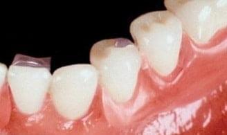  Invisible Partial Dentures